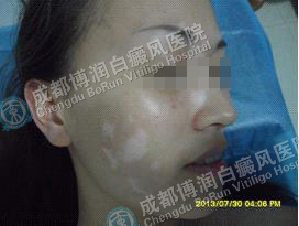 女性面颈部散发型白癜风6个月