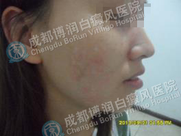 女性面颈部散发型白癜风6个月