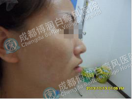女性面颈部散发型白癜风6个月
