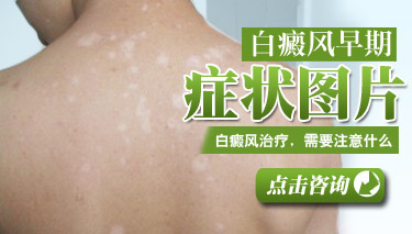 白癜风可治愈吗