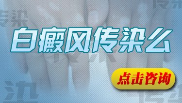 白癜风会传染给别人吗